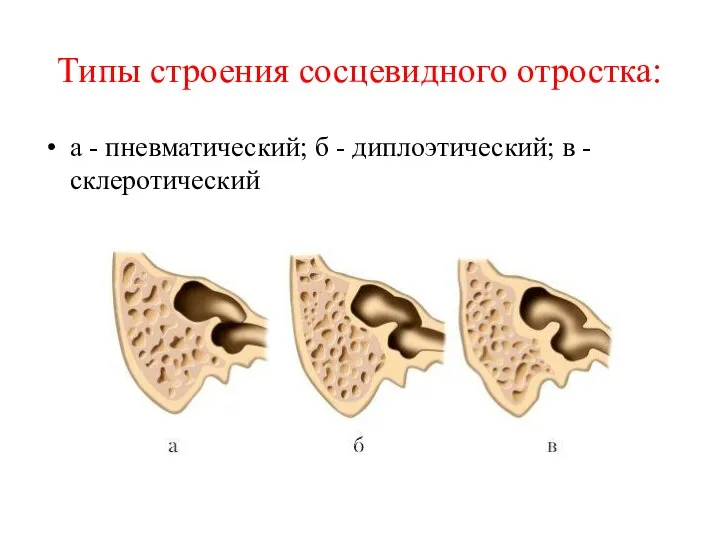 Типы строения сосцевидного отростка: а - пневматический; б - диплоэтический; в - склеротический