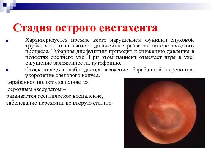 Стадия острого евстахеита Характеризуется прежде всего нарушением функции слуховой трубы, что