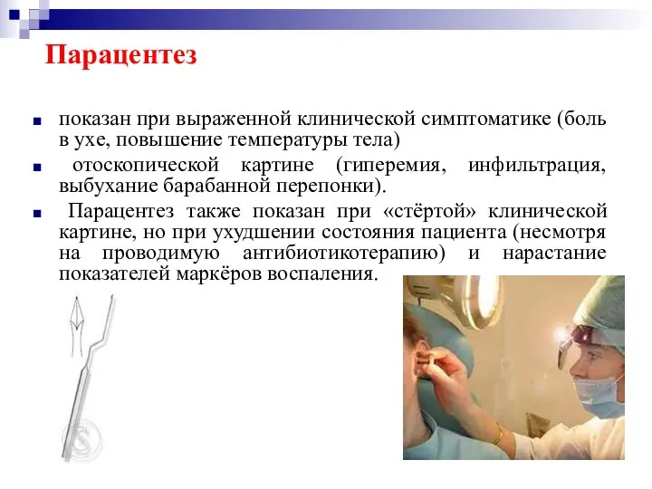 Парацентез показан при выраженной клинической симптоматике (боль в ухе, повышение температуры