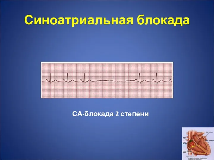 Синоатриальная блокада СА-блокада 2 степени