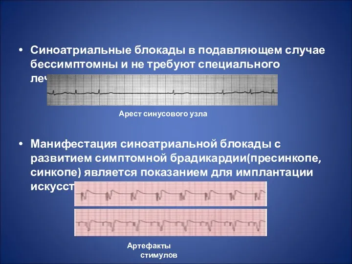 Синоатриальные блокады в подавляющем случае бессимптомны и не требуют специального лечения.