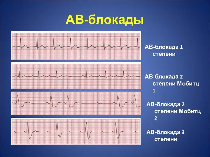 АВ-блокады АВ-блокада 1 степени АВ-блокада 2 степени Мобитц 1 АВ-блокада 2