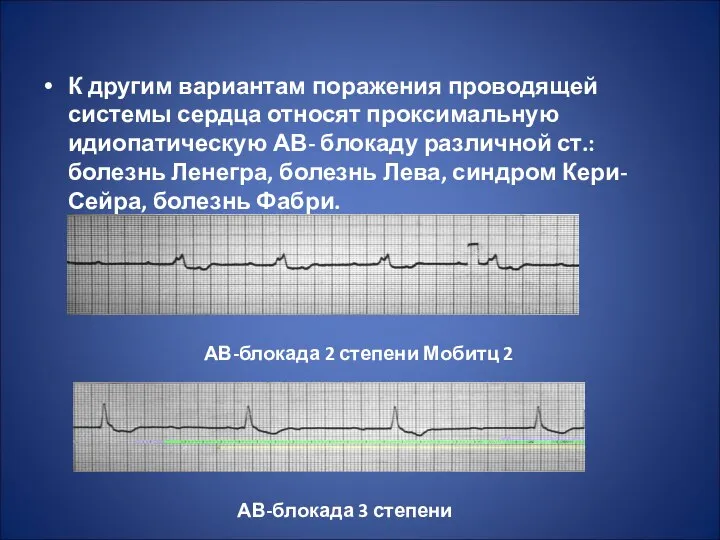 К другим вариантам поражения проводящей системы сердца относят проксимальную идиопатическую АВ-