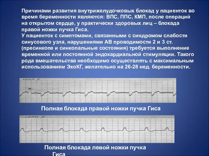 Причинами развития внутрижелудочковых блокад у пациенток во время беременности являются: ВПС,