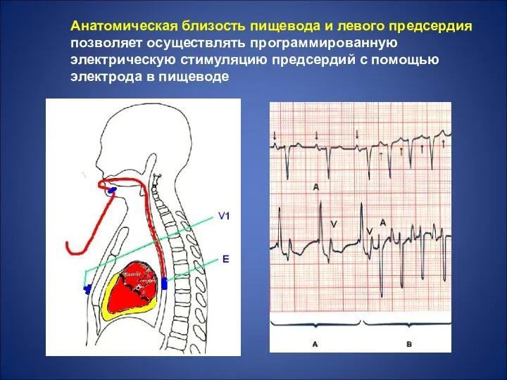 Анатомическая близость пищевода и левого предсердия позволяет осуществлять программированную электрическую стимуляцию