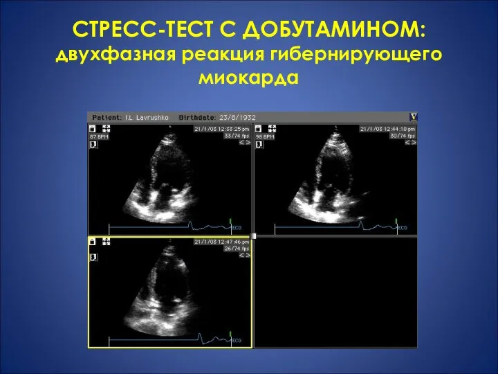 СТРЕСС-ТЕСТ С ДОБУТАМИНОМ: двухфазная реакция гибернирующего миокарда