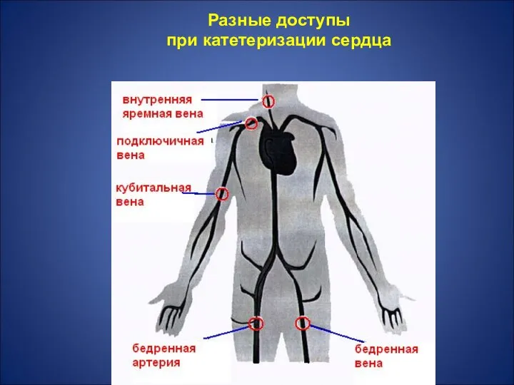 Разные доступы при катетеризации сердца