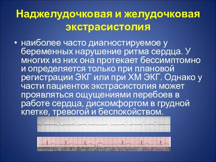 Наджелудочковая и желудочковая экстрасистолия наиболее часто диагностируемое у беременных нарушение ритма