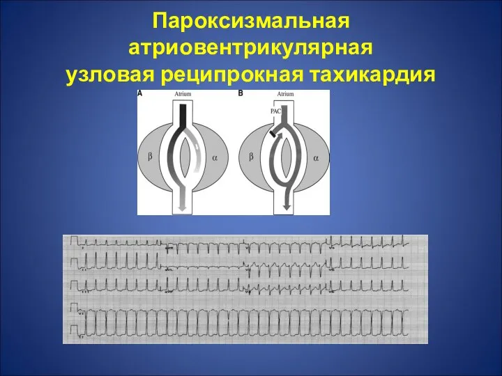 Пароксизмальная атриовентрикулярная узловая реципрокная тахикардия