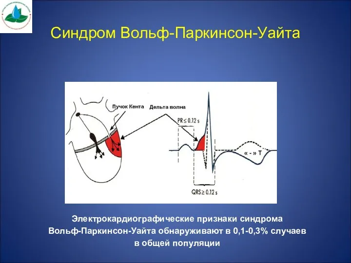 Синдром Вольф-Паркинсон-Уайта Электрокардиографические признаки синдрома Вольф-Паркинсон-Уайта обнаруживают в 0,1-0,3% случаев в общей популяции