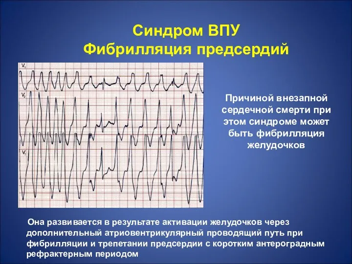 Причиной внезапной сердечной смерти при этом синдроме может быть фибрилляция желудочков