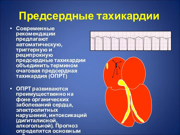 Предсердные тахикардии Современные рекомендации предлагают автоматическую, триггерную и реципрокную предсердные тахикардии