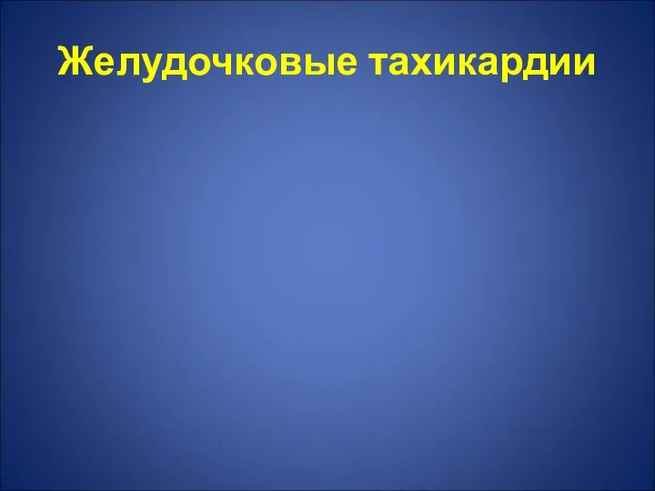 Желудочковые тахикардии