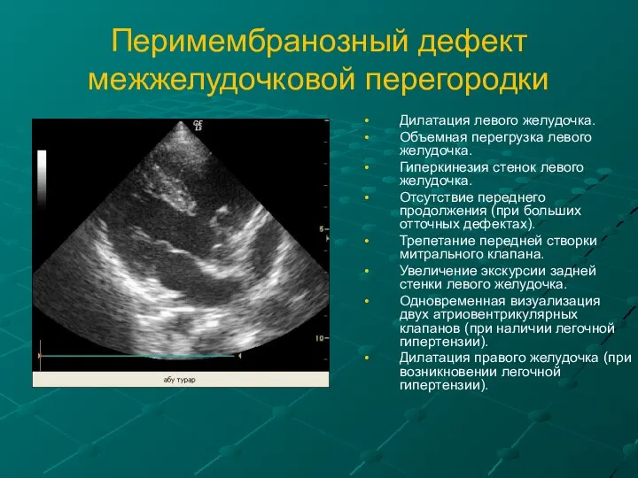 Перимембранозный дефект межжелудочковой перегородки Дилатация левого желудочка. Объемная перегрузка левого желудочка.