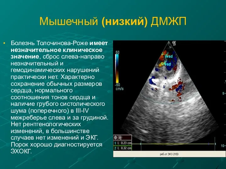 Мышечный (низкий) ДМЖП Болезнь Толочинова-Роже имеет незначительное клиническое значение, сброс слева-направо