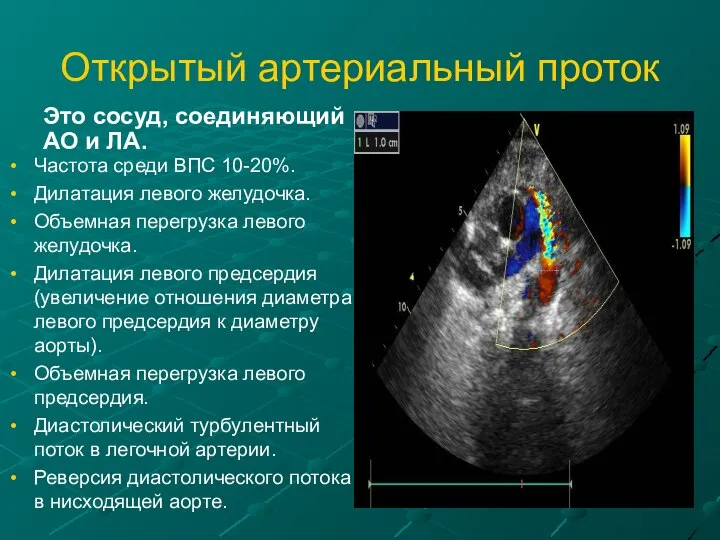 Открытый артериальный проток Это сосуд, соединяющий АО и ЛА. Частота среди