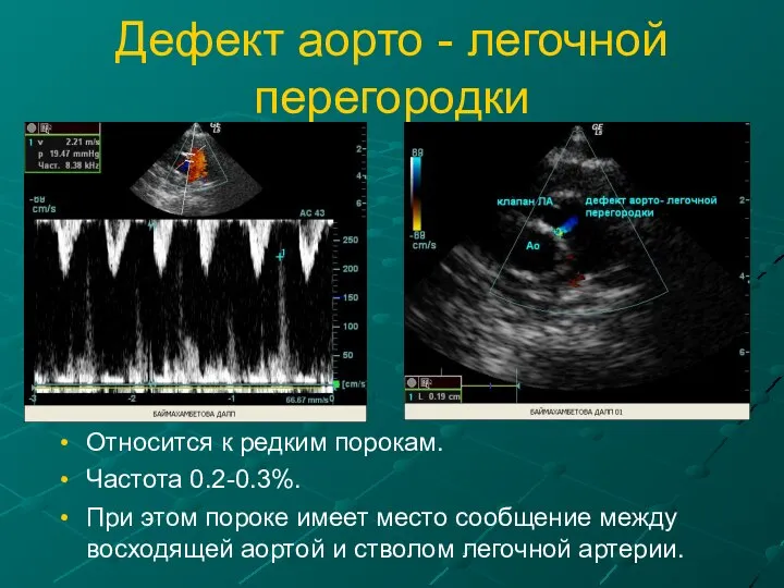 Дефект аорто - легочной перегородки Относится к редким порокам. Частота 0.2-0.3%.