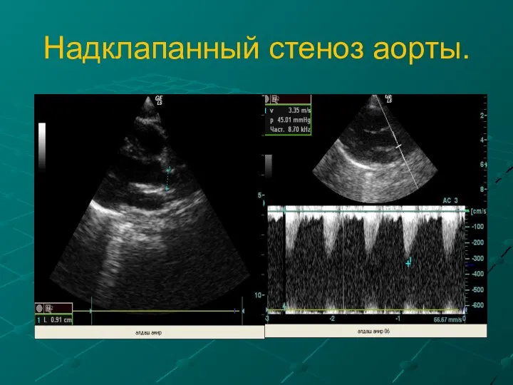 Надклапанный стеноз аорты.