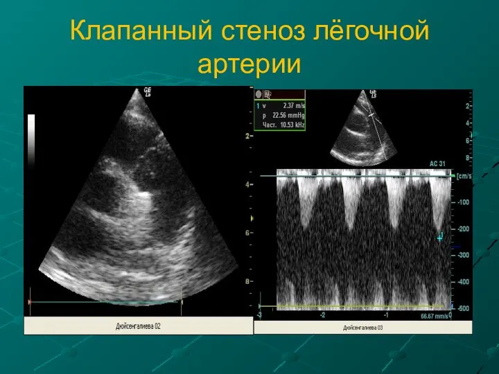 Клапанный стеноз лёгочной артерии