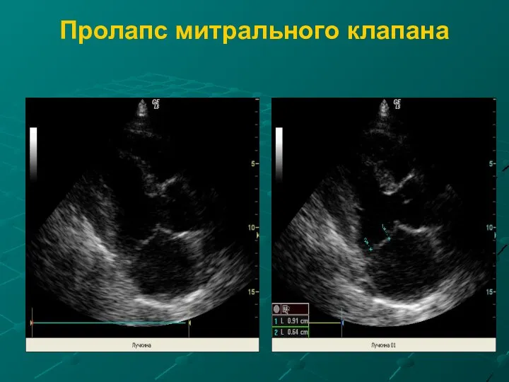 Пролапс митрального клапана