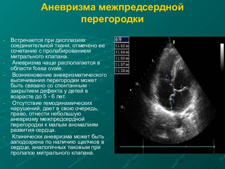 Аневризма межпредсердной перегородки Встречается при дисплазиях соединительной ткани, отмечено ее сочетание