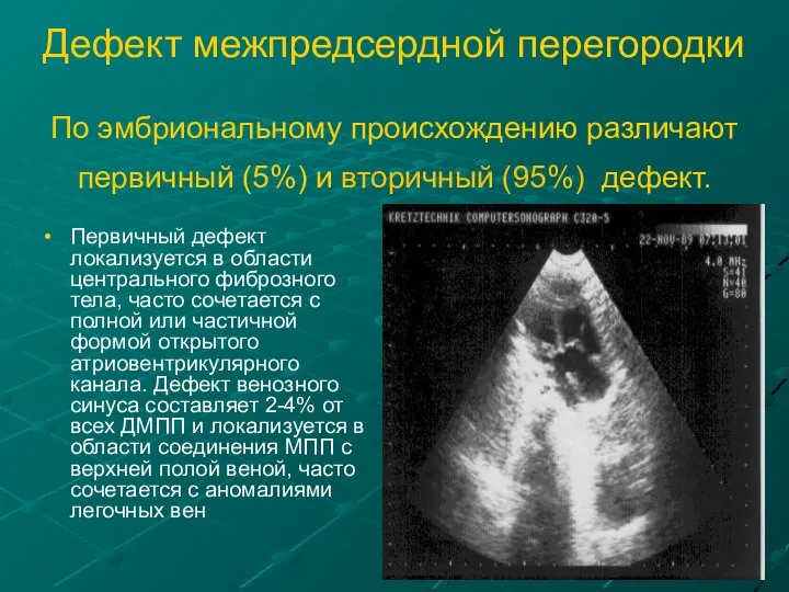 Дефект межпредсердной перегородки По эмбриональному происхождению различают первичный (5%) и вторичный