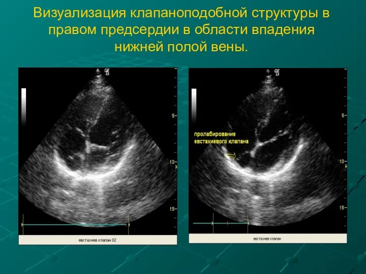 Визуализация клапаноподобной структуры в правом предсердии в области впадения нижней полой вены.