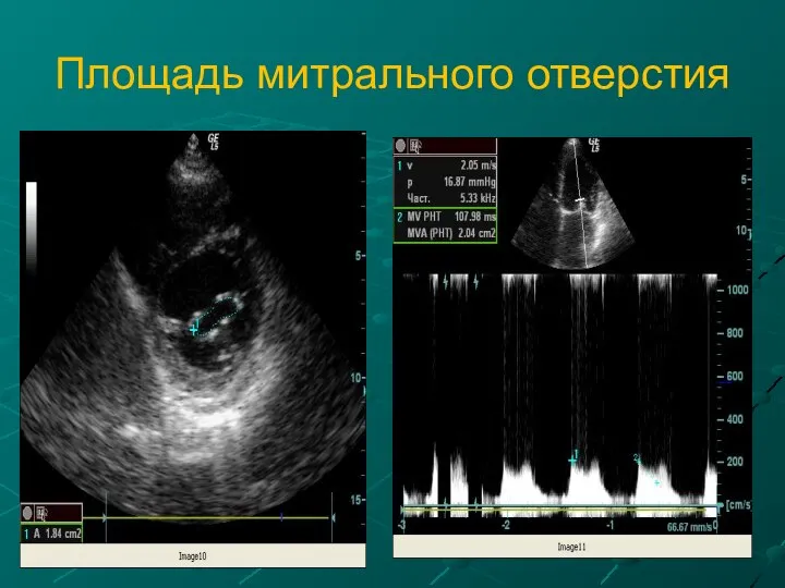 Площадь митрального отверстия