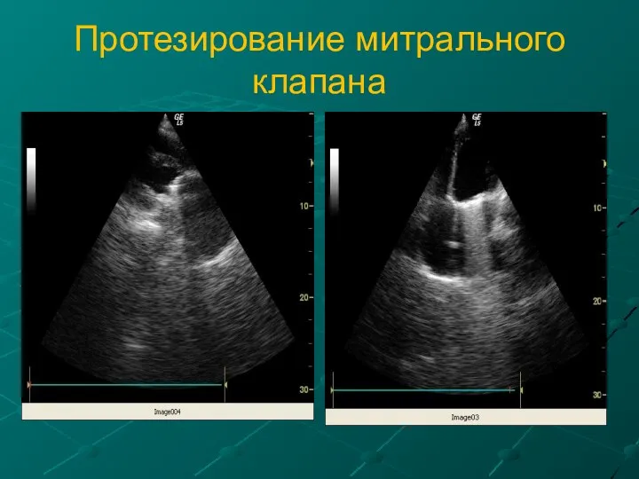 Протезирование митрального клапана