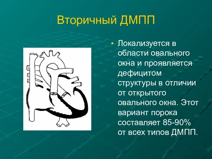 Вторичный ДМПП Локализуется в области овального окна и проявляется дефицитом структуры