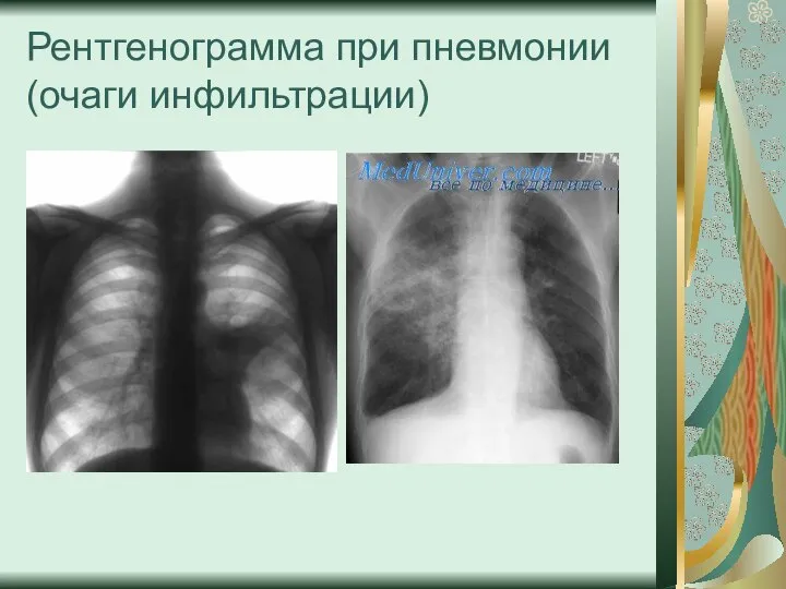 Рентгенограмма при пневмонии (очаги инфильтрации)