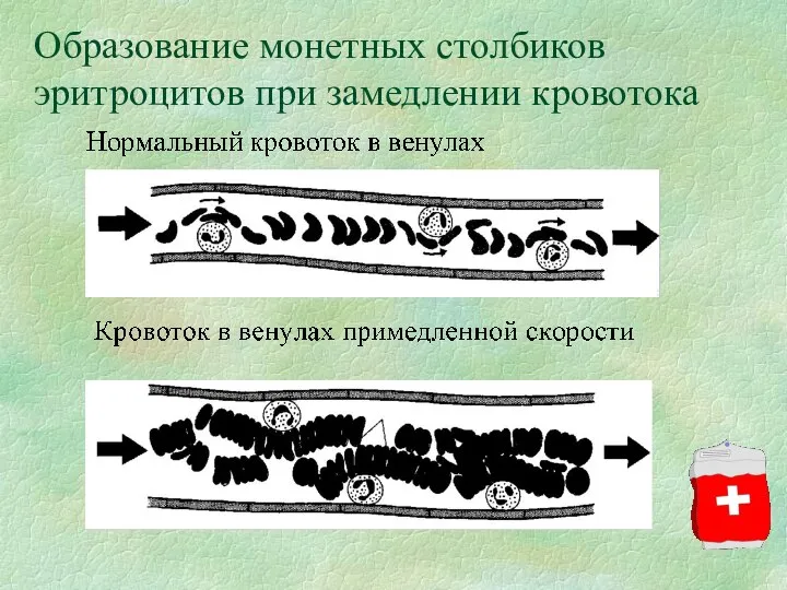 Образование монетных столбиков эритроцитов при замедлении кровотока