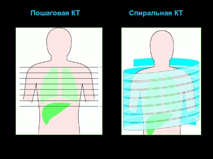 Пошаговая КТ Спиральная КТ