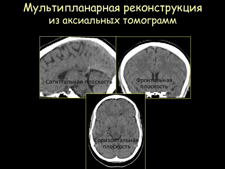 Мультипланарная реконструкция из аксиальных томограмм Головной мозг Сагиттальная плоскость Фронтальная плоскость Горизонтальная плоскость