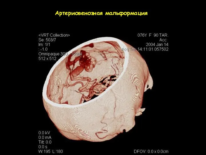 Артериовенозная мальформация