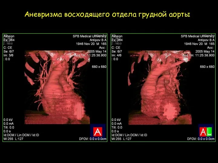 Аневризма восходящего отдела грудной аорты