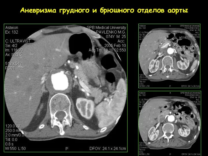 Аневризма грудного и брюшного отделов аорты