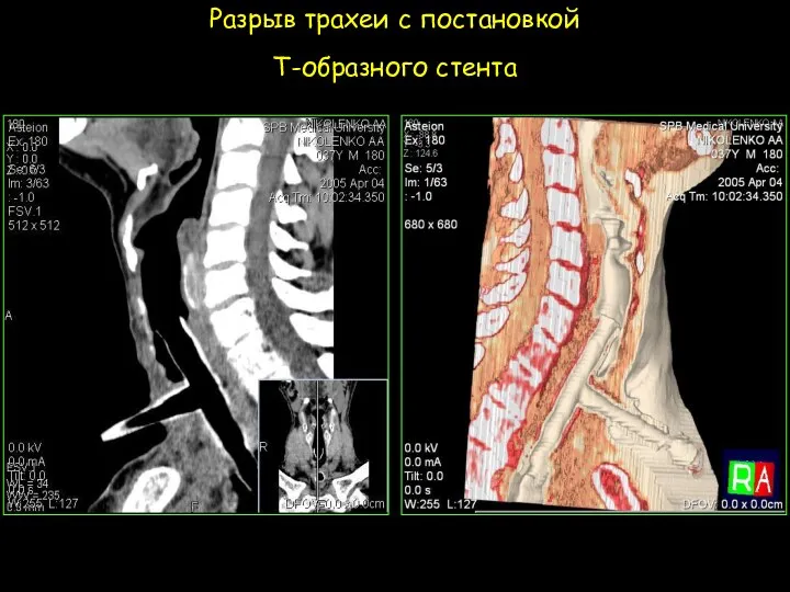 Разрыв трахеи с постановкой Т-образного стента