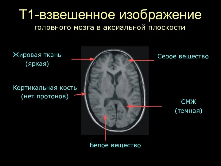 Т1-взвешенное изображение Жировая ткань (яркая) СМЖ (темная) Кортикальная кость (нет протонов)