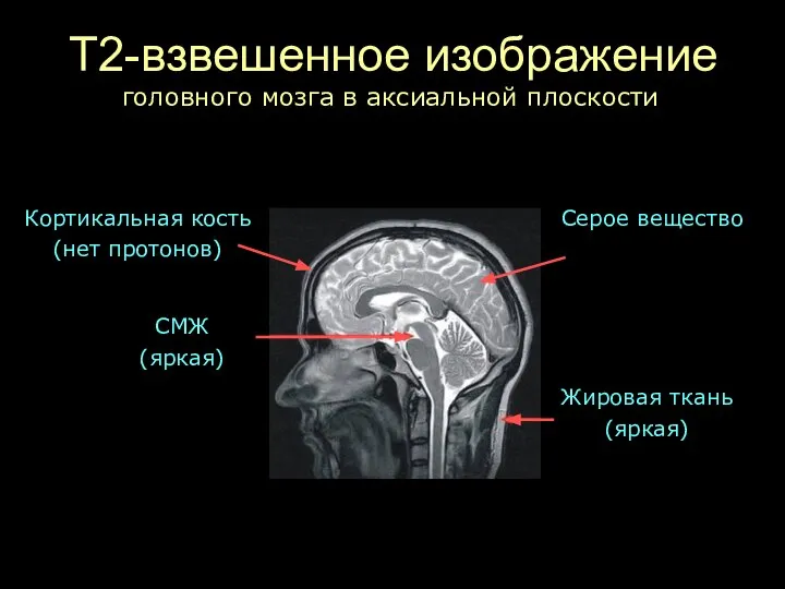 Т2-взвешенное изображение СМЖ (яркая) Жировая ткань (яркая) Кортикальная кость (нет протонов)