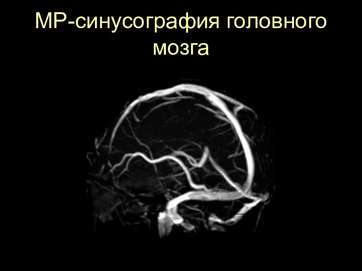 МР-синусография головного мозга Верхний сагиттальный синус Сигмовидный синус Поперечный синус Большая вена Галена Прямой синус