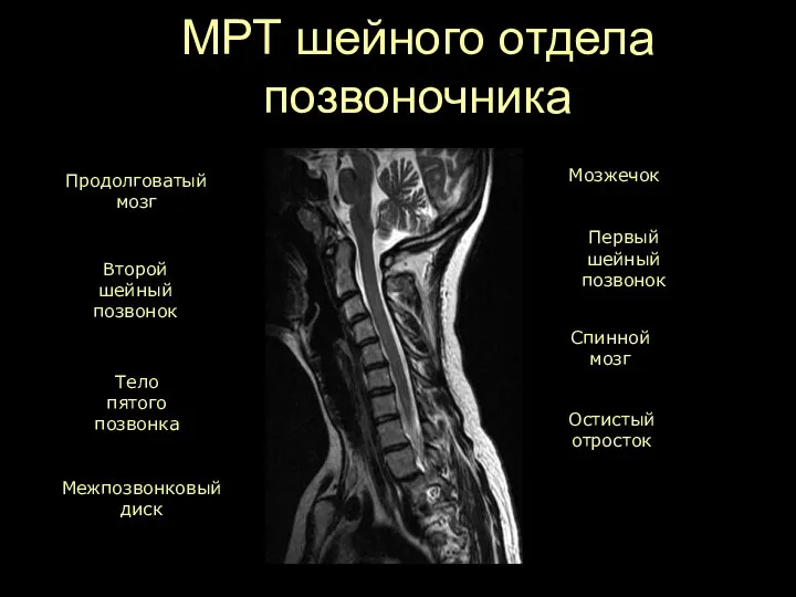 МРТ шейного отдела позвоночника Продолговатый мозг Спинной мозг Второй шейный позвонок