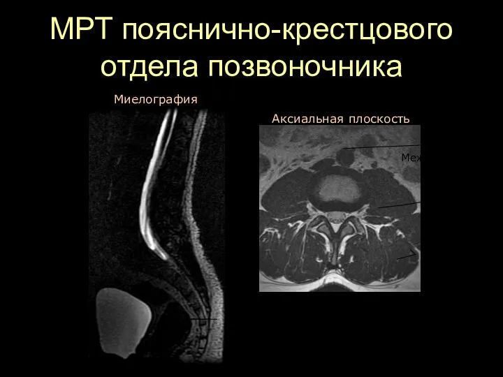 МРТ пояснично-крестцового отдела позвоночника Миелография Аксиальная плоскость Позвоночный канал Остистый отросток