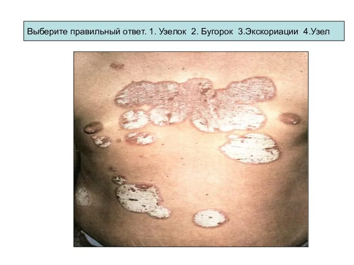 Выберите правильный ответ. 1. Узелок 2. Бугорок 3.Экскориации 4.Узел