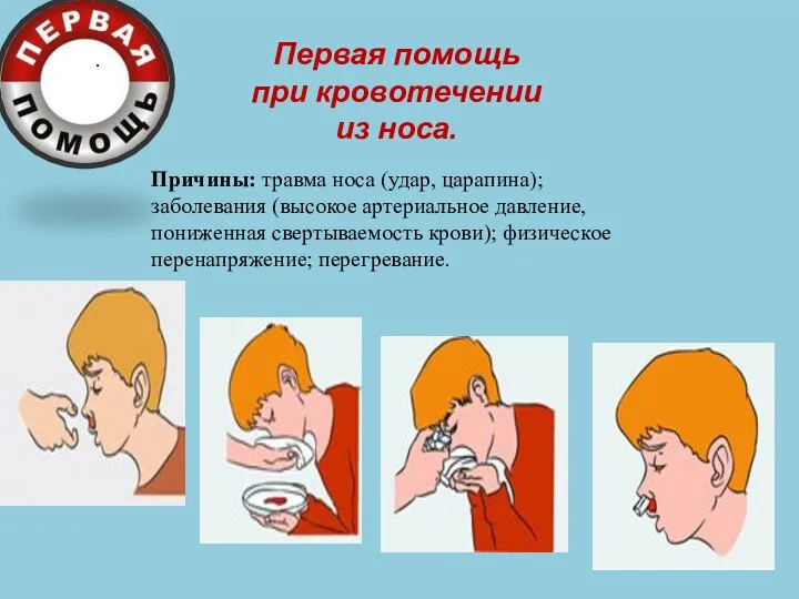 . Первая помощь при кровотечении из носа. Причины: травма носа (удар,
