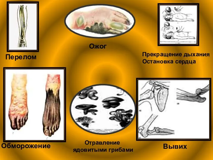 Перелом Ожог Прекращение дыхания Остановка сердца Обморожение Отравление ядовитыми грибами Вывих