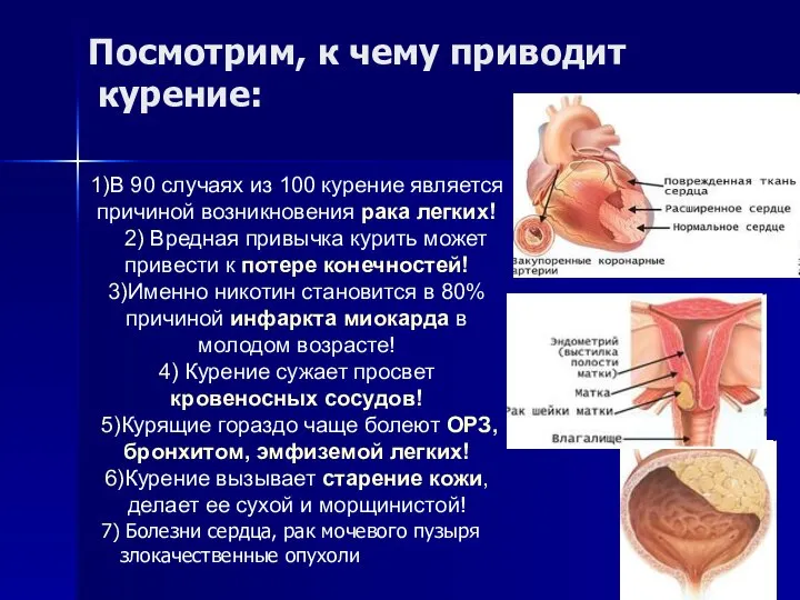 Посмотрим, к чему приводит курение: 1)В 90 случаях из 100 курение