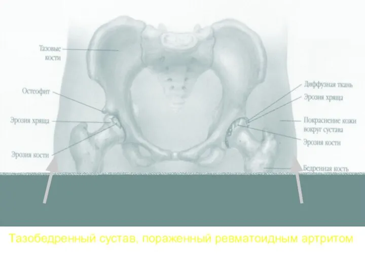 Тазобедренный сустав, пораженный ревматоидным артритом
