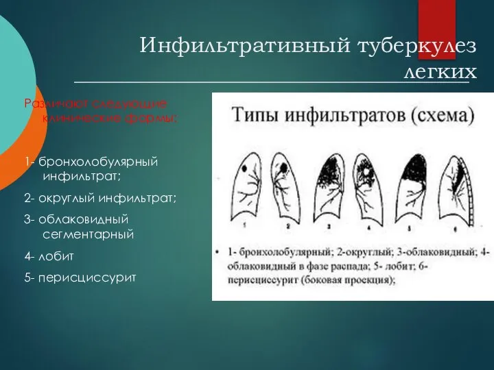 Инфильтративный туберкулез легких Различают следующие клинические формы: 1- бронхолобулярный инфильтрат; 2-