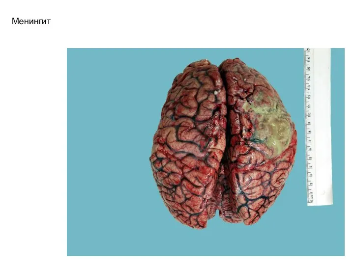 Менингит. Экзаменационный билет патан, препараты (пример) 13